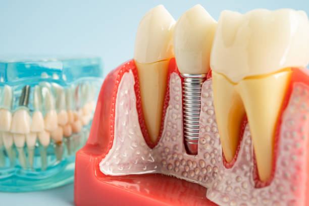 Best Wisdom Tooth Removal  in Porcupine, SD